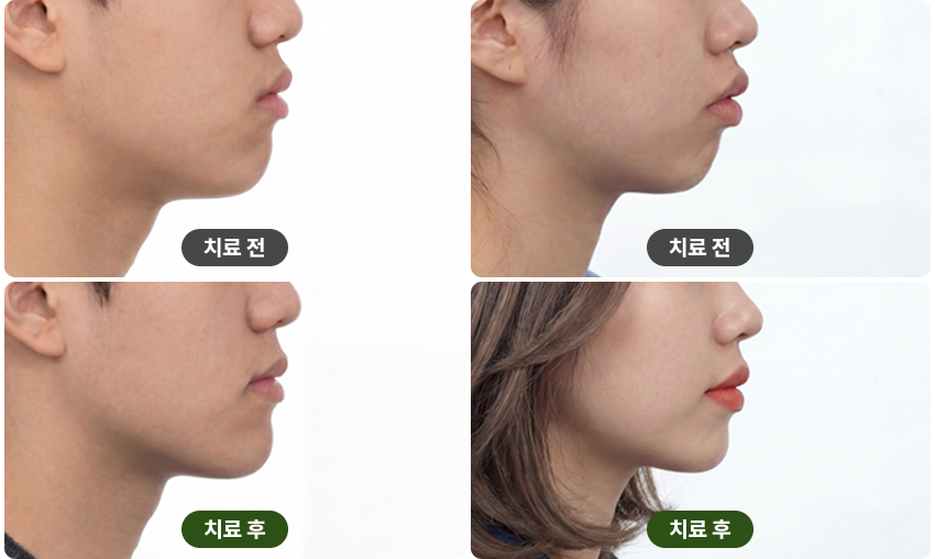 교정 치료 전후 사진