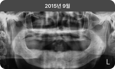 2015년 9월 초진 X-ray