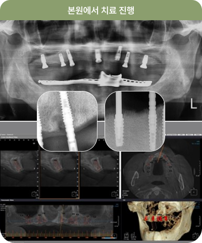 본원 치료 진행 X-ray